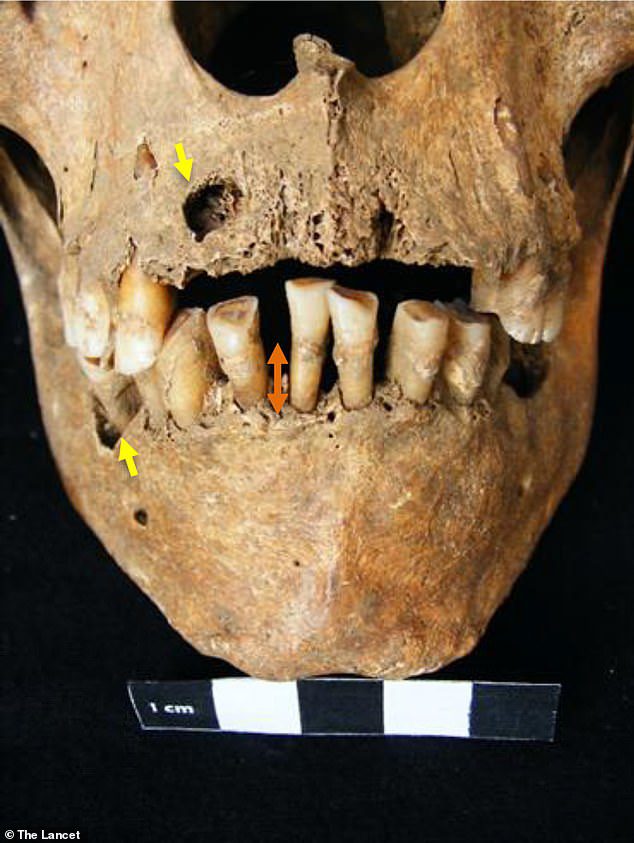 Obwohl die Archäologen nicht wussten, dass die Überreste von Krankheiten durchsetzt waren, weist der Schädel Spuren wie überdurchschnittlich große Zähne und eine schwere Zahnfleischentzündung auf, die das Weichgewebe in seinem Mund vor dem Tod beschädigte.